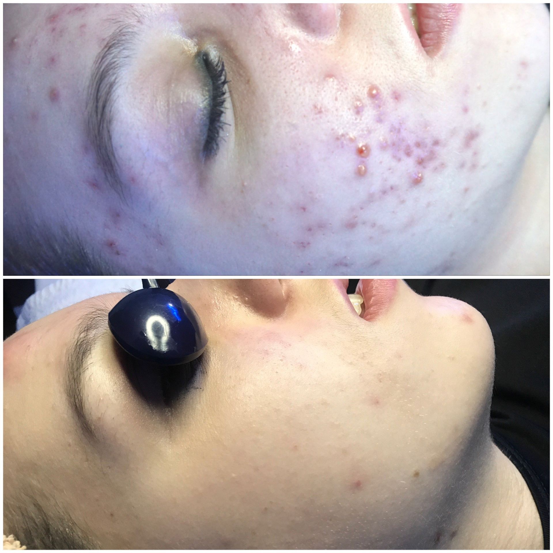 cheek augmentation will fillers