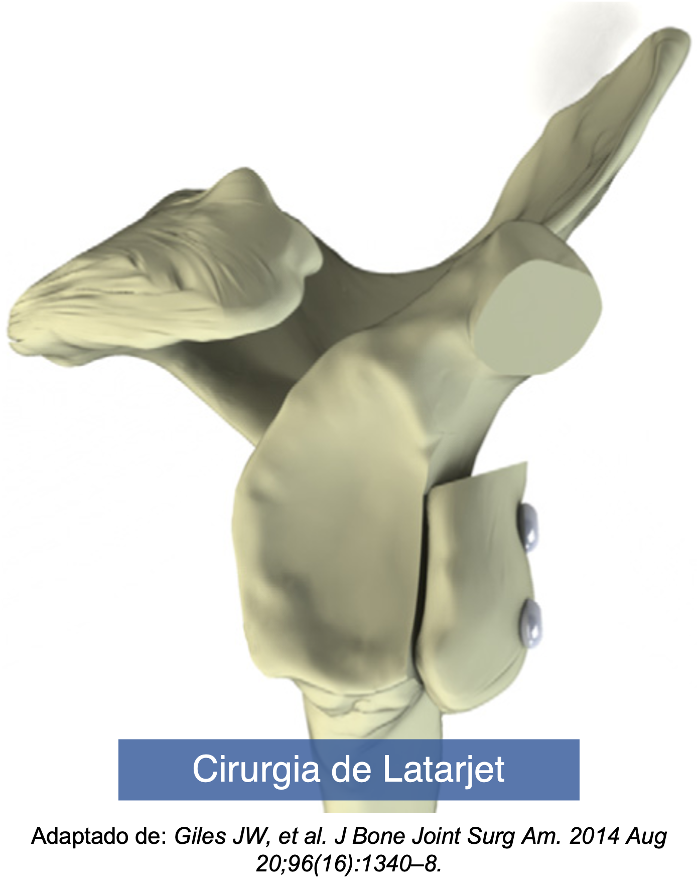 Tomografia computadorizada 3D da escápula com enxerto ósseo retirado do processo coracoide fixado na borda anterior da glenoide com 02 parafusos (procedimento de bloqueio ósseo - cirurgia de Latarjet)