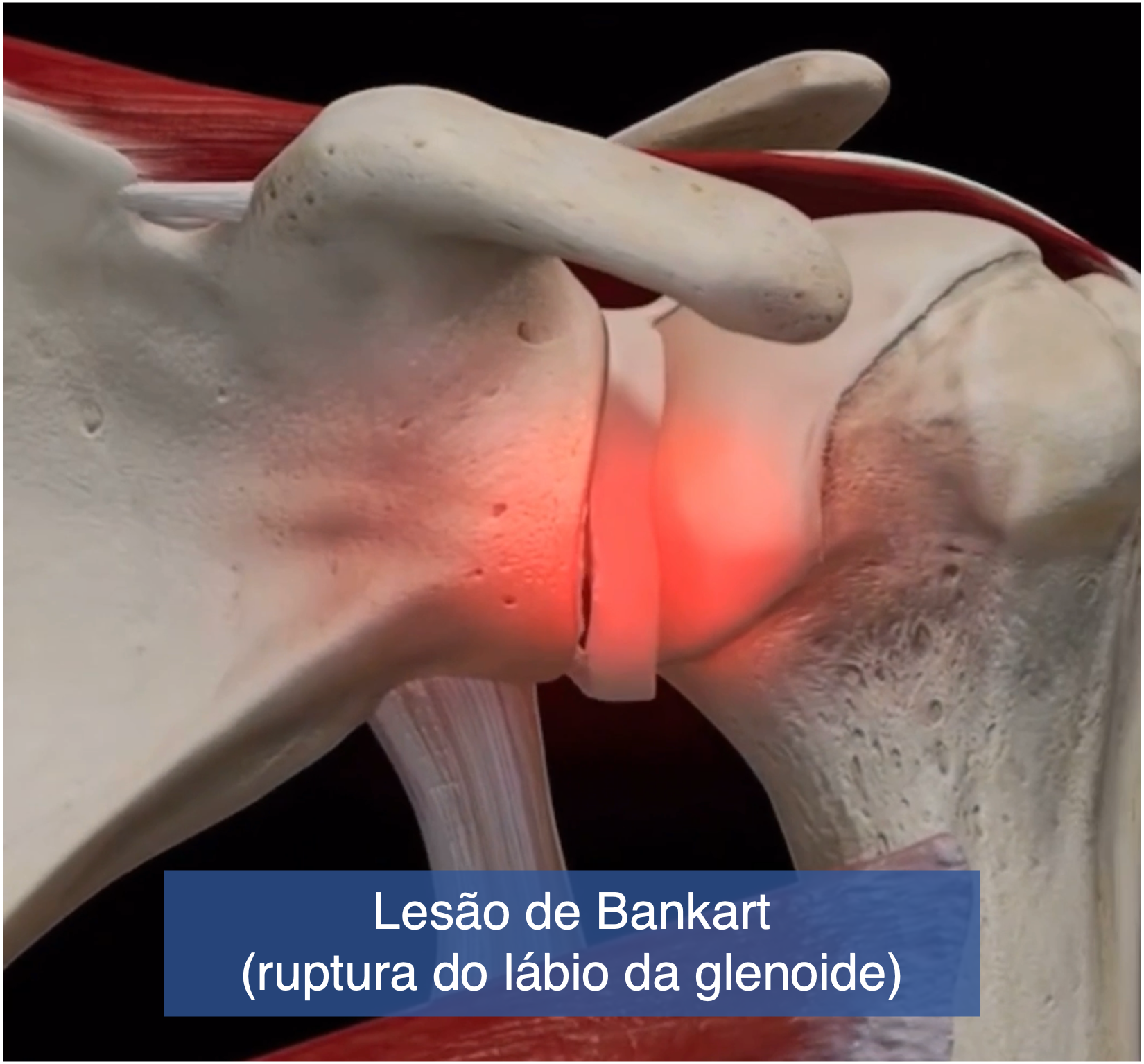 Imagem frontal da articulação glenoumeral com área de ruptura na base do lábio anterior da glenoide