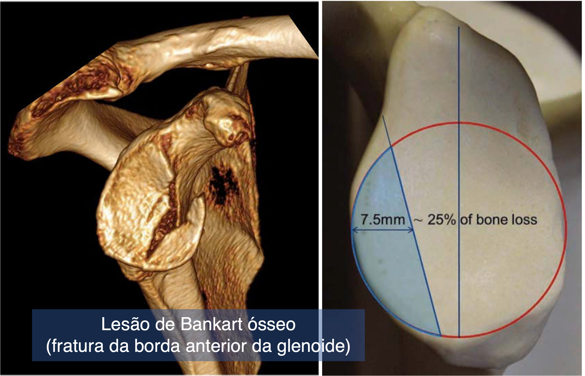 Imagem de tomografia computadorizada com reconstrução 3D demonstrando fratura da borda anterior da glenoide (lesão de Bankart ósseo)