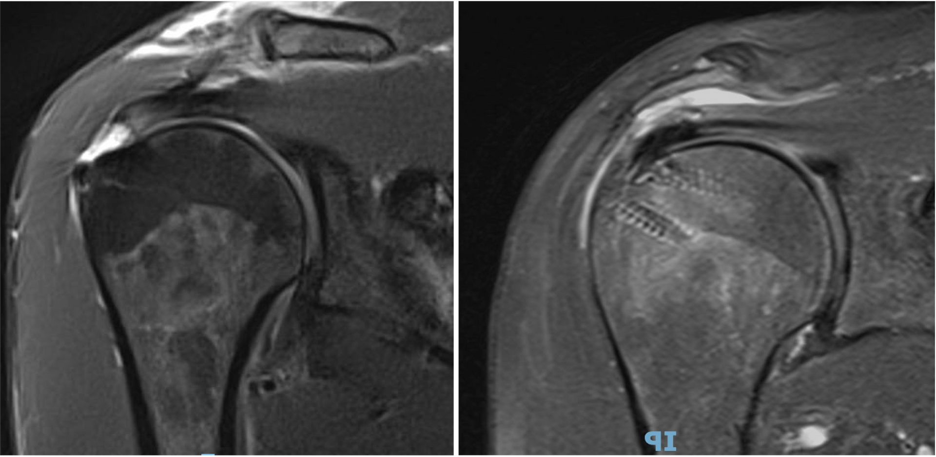 Imagem de ressonância magnética - pré e pós-operatório