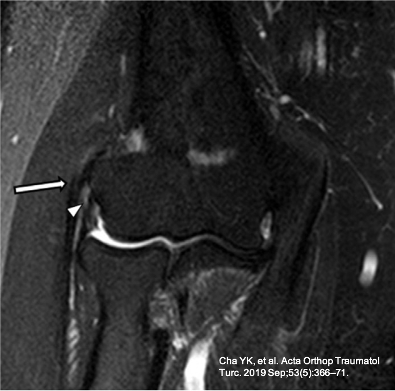 Imagem de ressonância magnética do cotovelo com lesão parcial do tendão extensor comum na epicondilite lateral