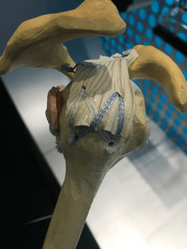 Demonstração de reparo cirúrgico do manguito rotador: os tendões são reinseridos ao osso com 'âncoras' de fixação