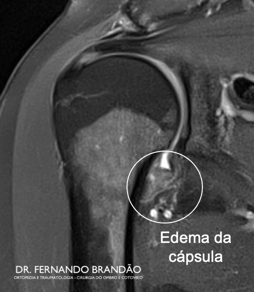 Imagem de ressonancia magnetica com edema e aderencia da capsula inferior do ombro na capsulite adesiva (ombro congelado)