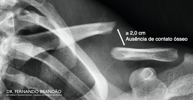 Radiografia demonstra fratura da clavícula com desvio maior que 2,0 cm e ausência de contato ósseo