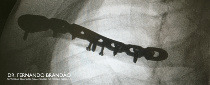 Radiografia de fratura da clavícula fixada com placa bloqueada pré-moldada