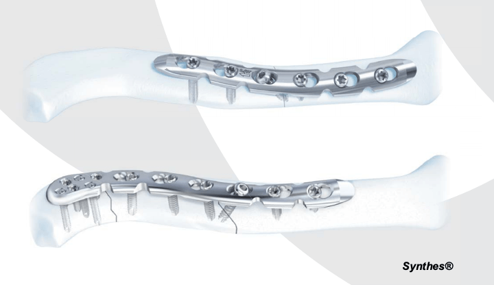Tipos de placa pré-moldadas para a fixação de fratura da clavícula.