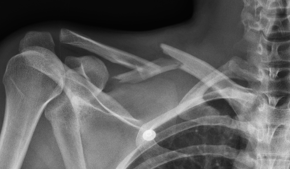 Radiografia demonstra fratura da clavícula (terço médio) com desvio e fragmentação.