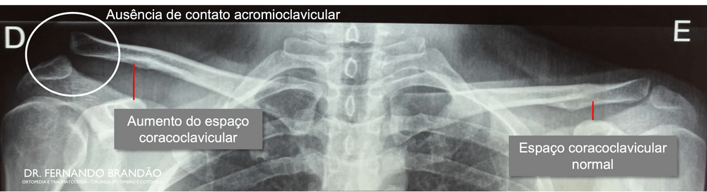 Radiografia acromioclavicular bilateral com aumento do espaço coracoclavicular do lado direito e ausência de contato entre a clavícula e o acrômio.