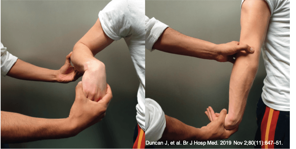 Teste de Mill para o diagnóstico da epicondilite lateral do cotovelo ('tennis elbow / cotovelo do tenista')