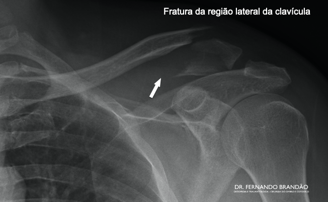 Fratura da extremidade lateral da clavícula (terço lateral) com desvio dos fragmentos.