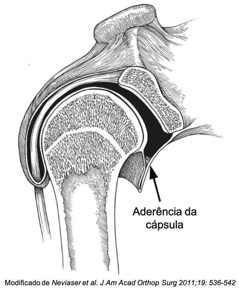 Aderência da cápsula articular glenoumeral no ombro congelado - capsulite adesiva