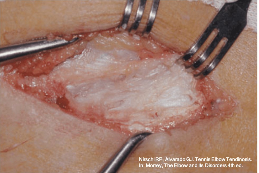 Tratamento cirúrgico para epicondilite lateral: a porção degenerada do tendão extensor ('tendinose com hiperplasia angiofibroblástica') é retirada.