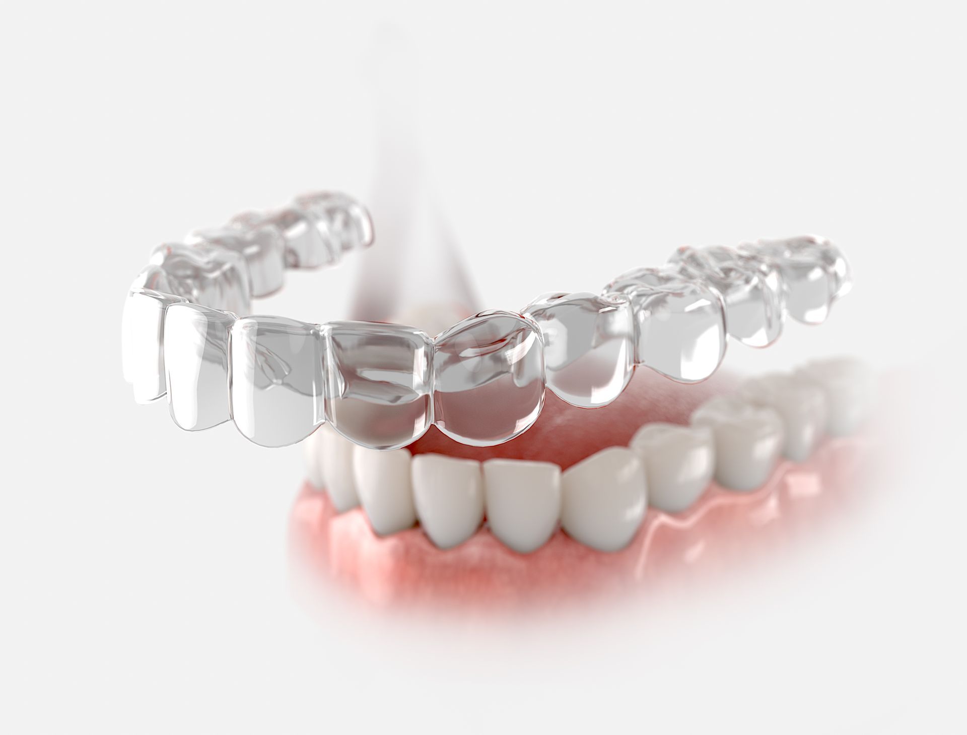 Clear aligner tray positioned over teeth, demonstrating orthodontic treatment. — McDonald Dental in Gympie, QLD