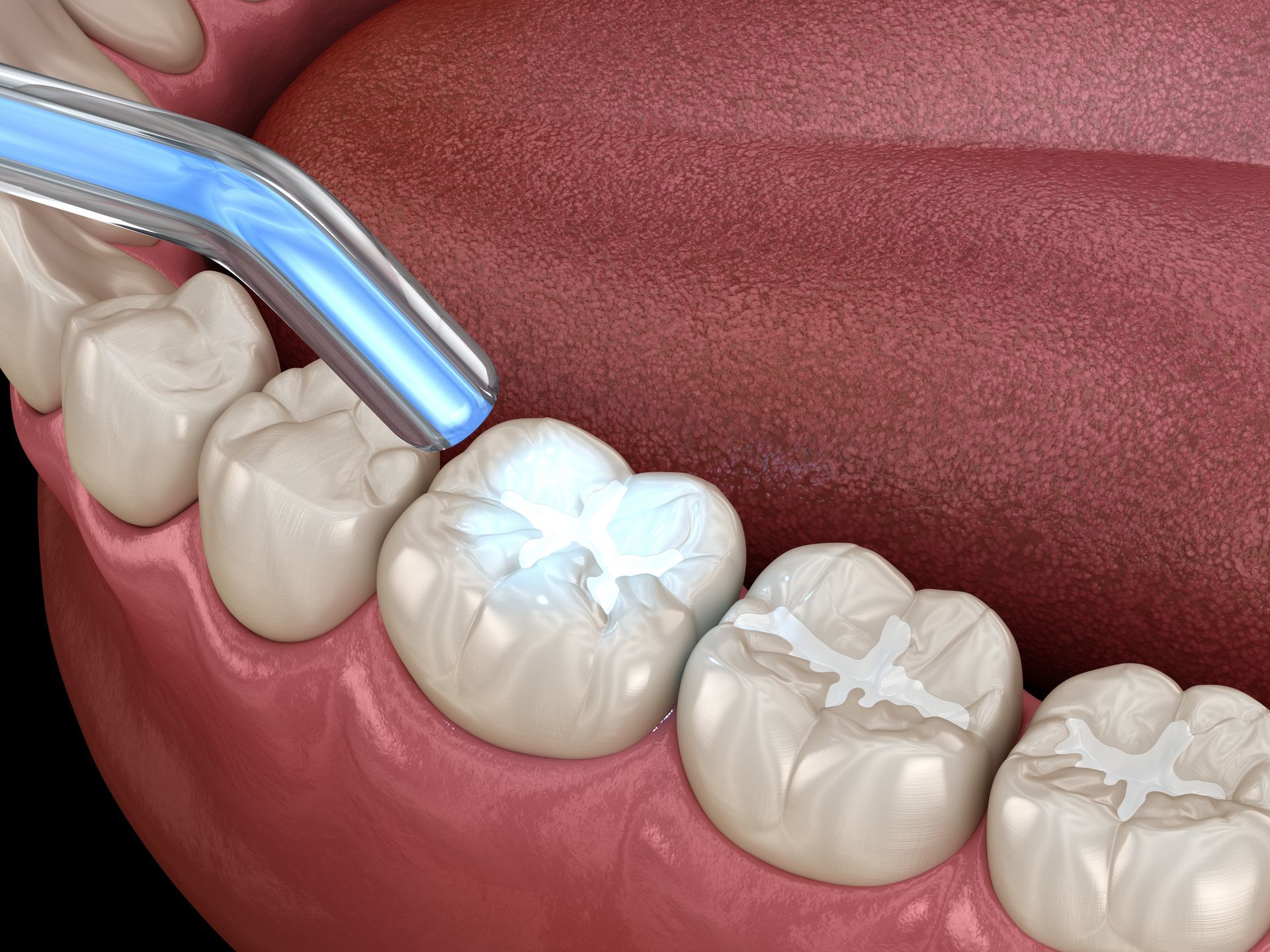 Dental procedure on a molar; blue light is applied to tooth filling. — McDonald Dental in Gympie, QLD
