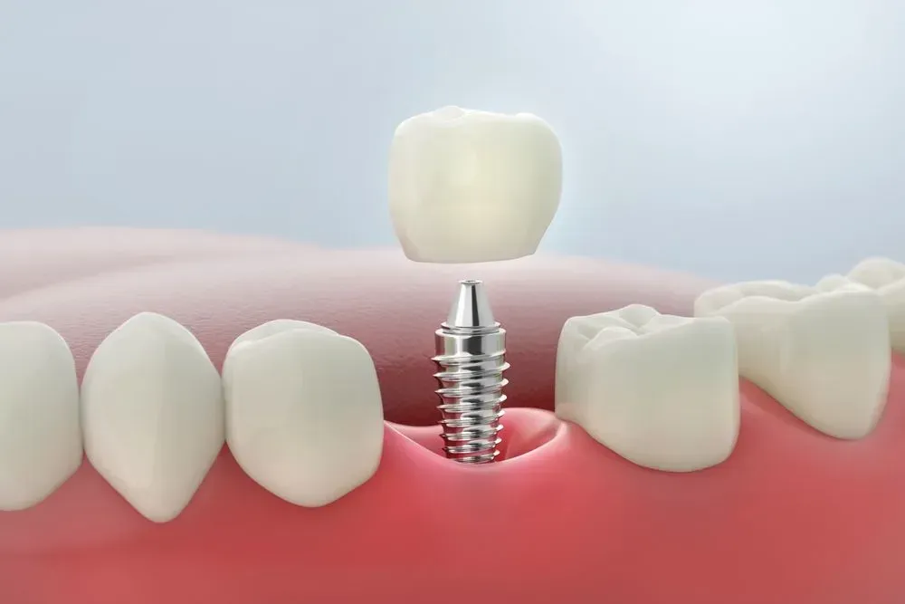 Dental implant illustration: a crown above a screw implant in a gum with adjacent teeth. — McDonald Dental in Gympie, QLD