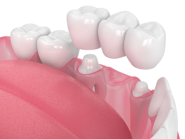 Prosthetic Teeth — Metairie, LA — Jeffry Leeson, DDS