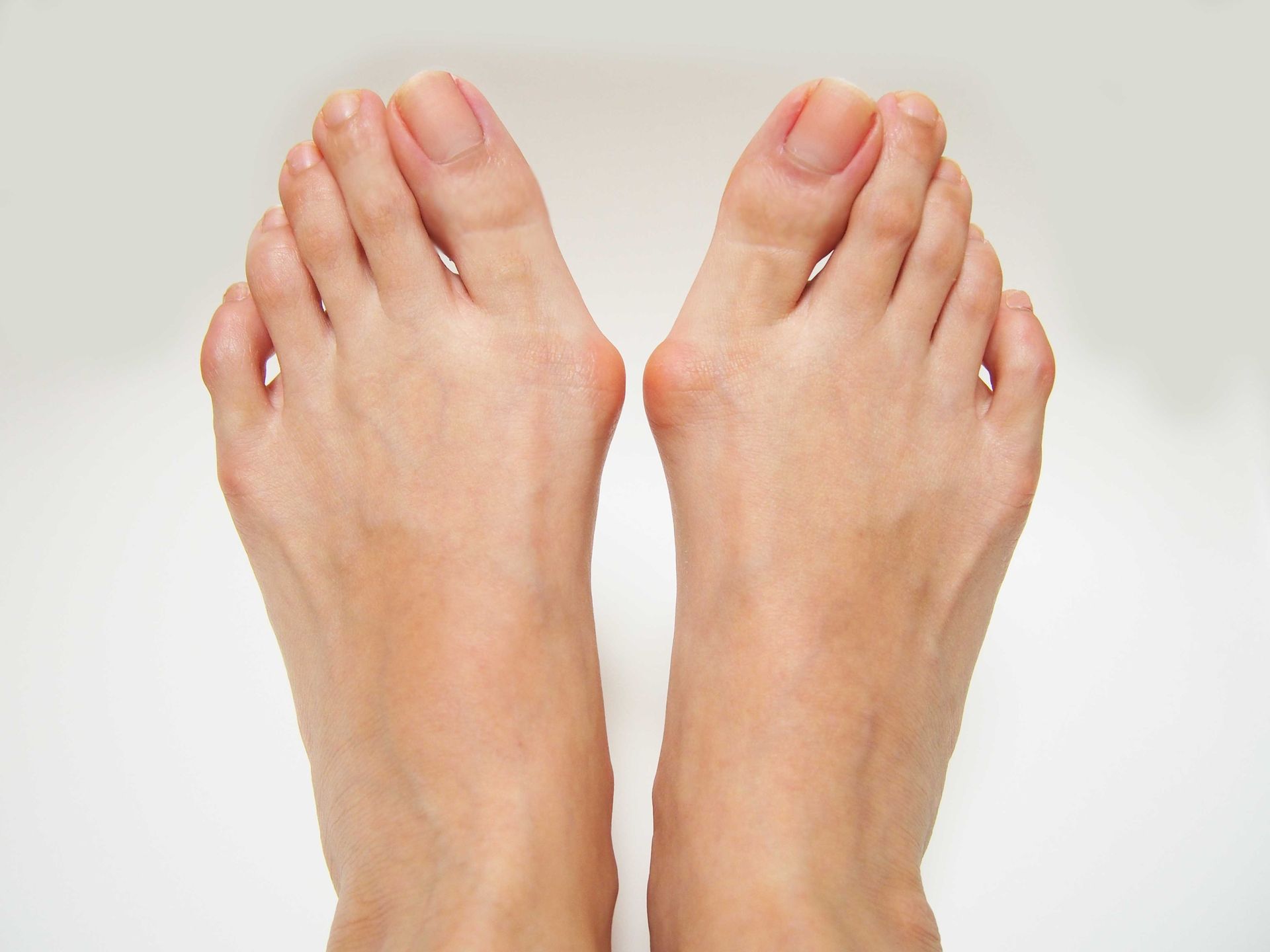 Pair of bare feet with bunions on the big toes, on a white background.