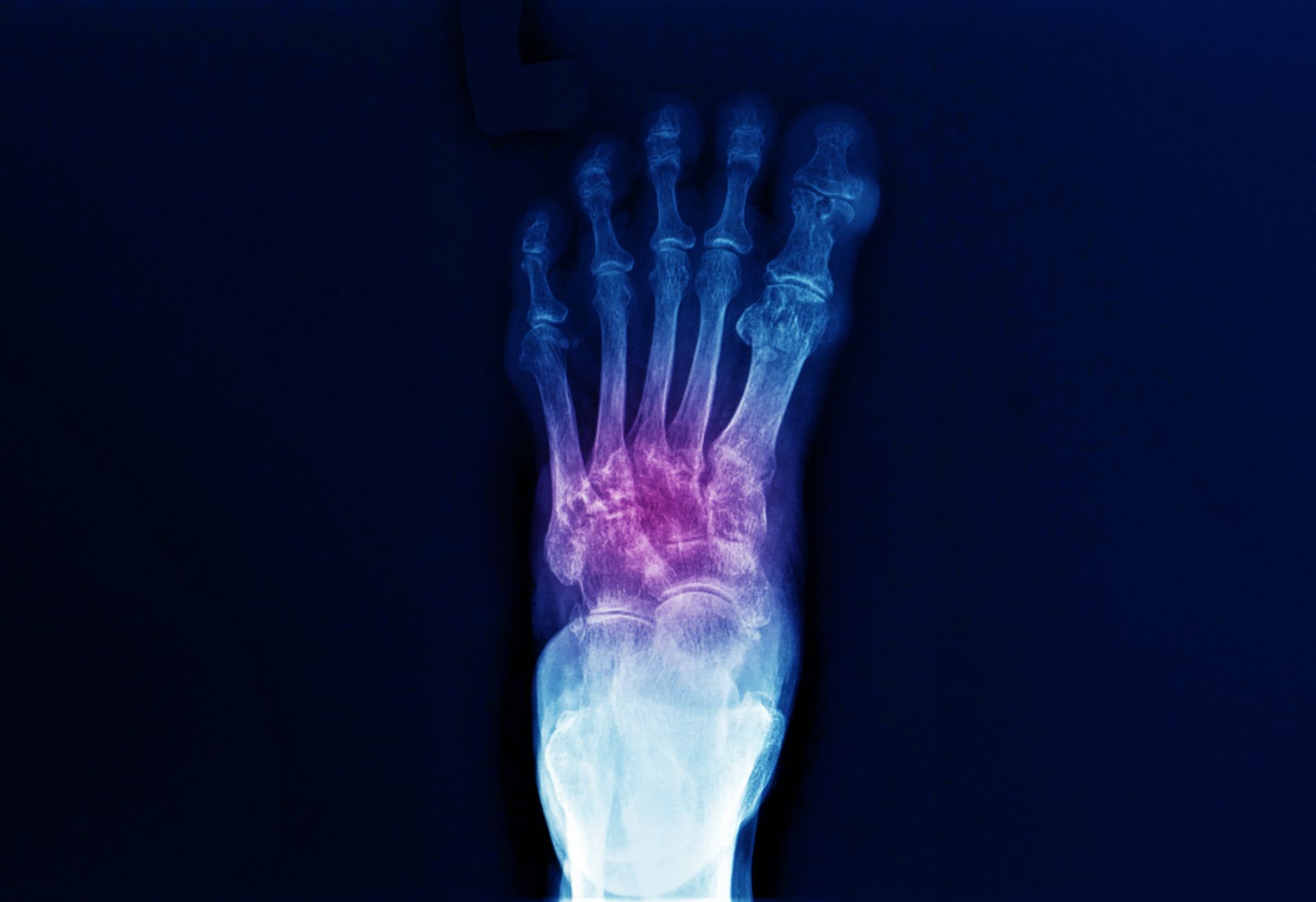 X-ray of a foot, showing inflammation and joint damage, highlighted in shades of purple and pink against a dark blue background.