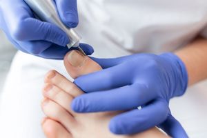 A person's foot being treated by a professional; a podiatrist using a tool on a toenail.