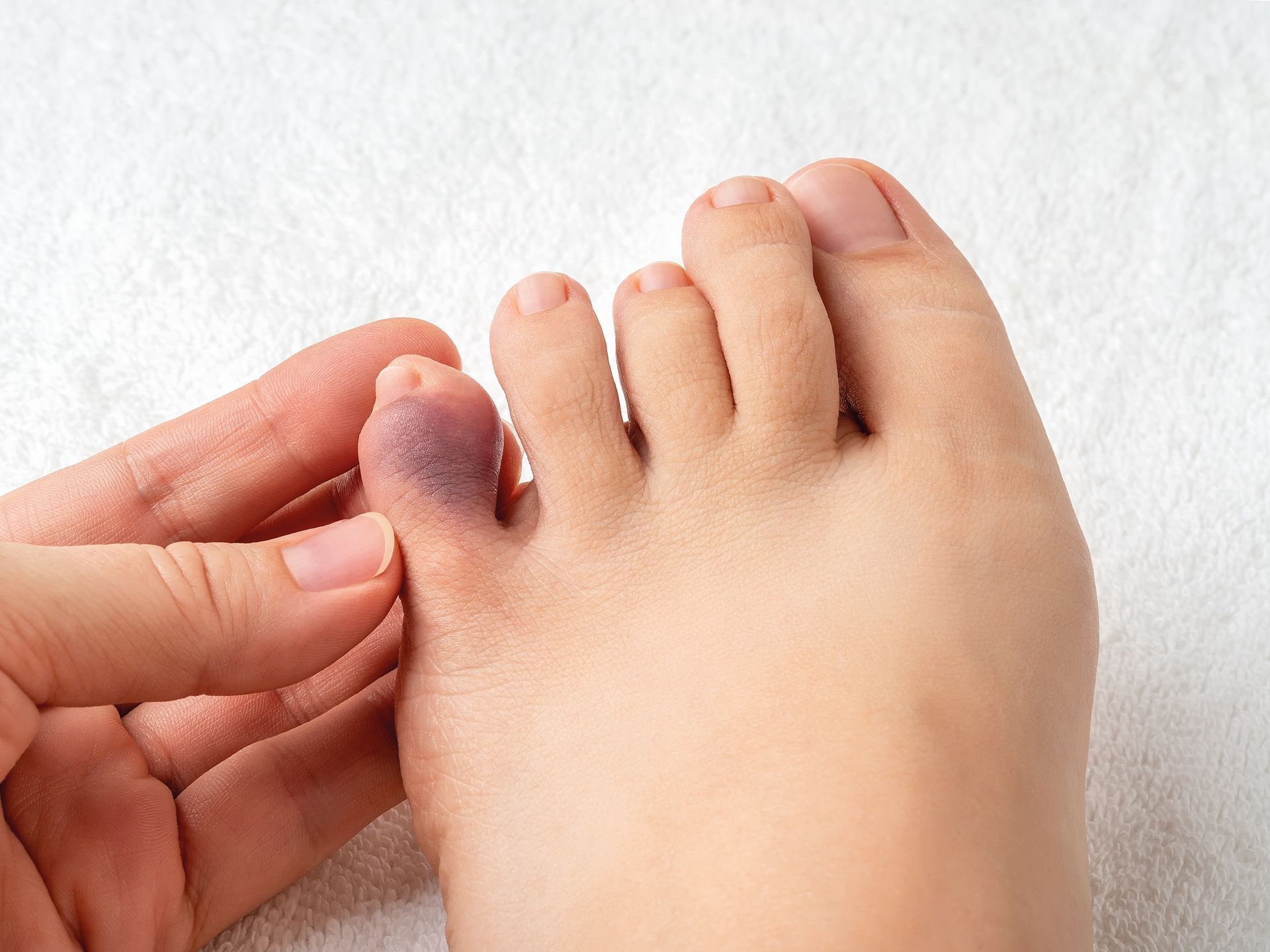 Foot with a bruised, discolored big toe being examined by a finger.
