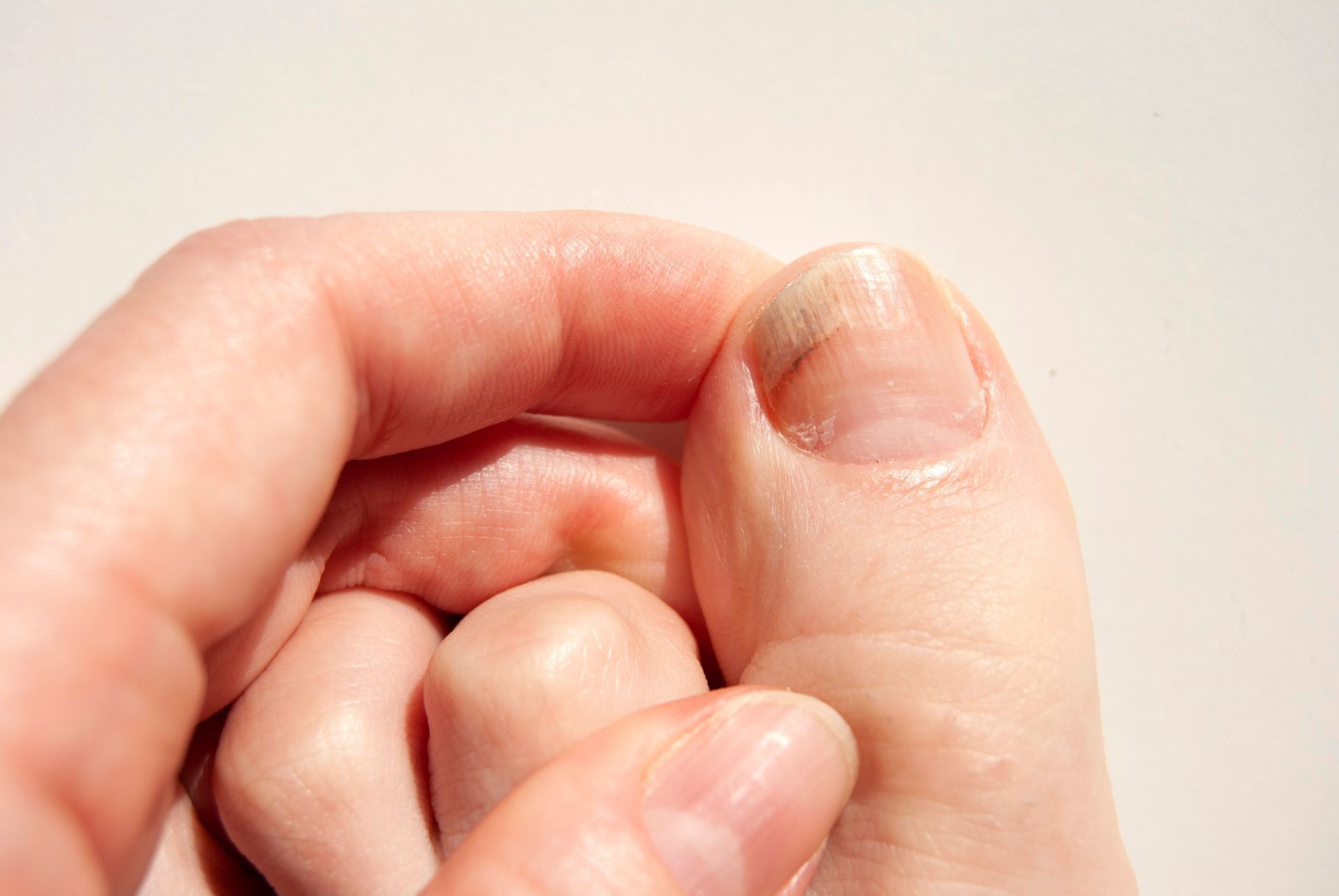 Close-up of a foot with a toenail showing signs of fungus, held by a hand against a white background.
