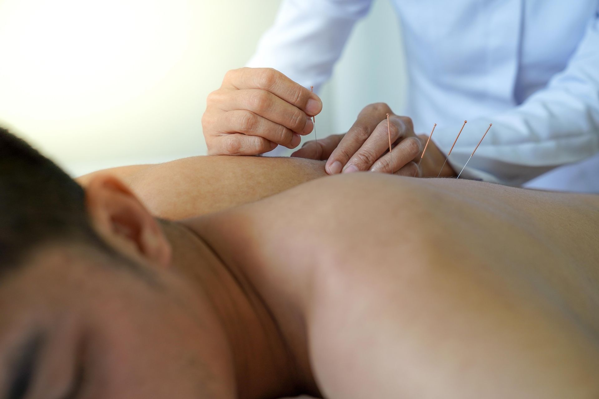 Person receiving acupuncture on their back; needles inserted by practitioner in a white coat.