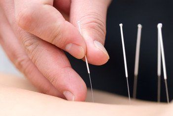 A hand inserting acupuncture needles