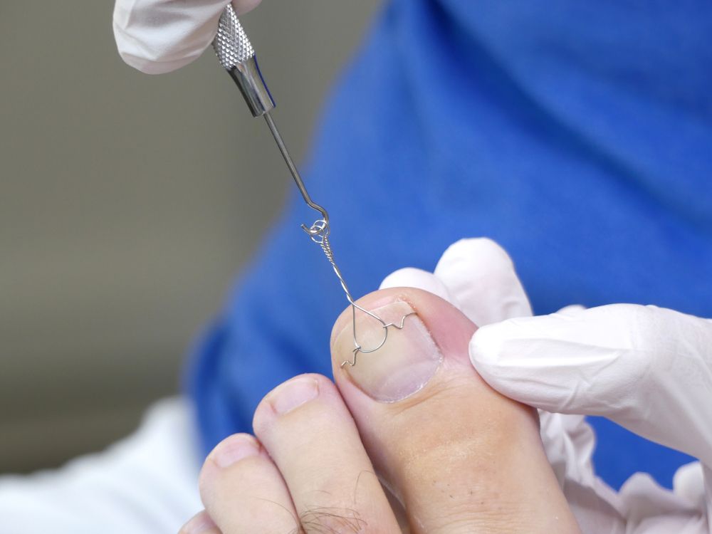 A Person is Getting Their Toenails Trimmed by a Doctor — Newcastle Foot & Ankle Clinic Charlestown In Charlestown, NSW