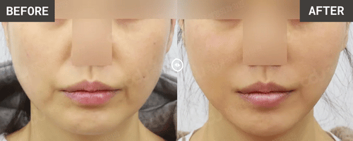 VXil Lifting + Buccal Fat Removal before & after