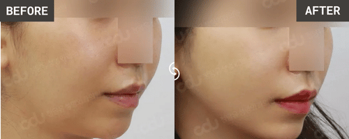 VXil Lifting + Double Chin Liposuction