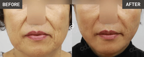 VXil Lifting before & after