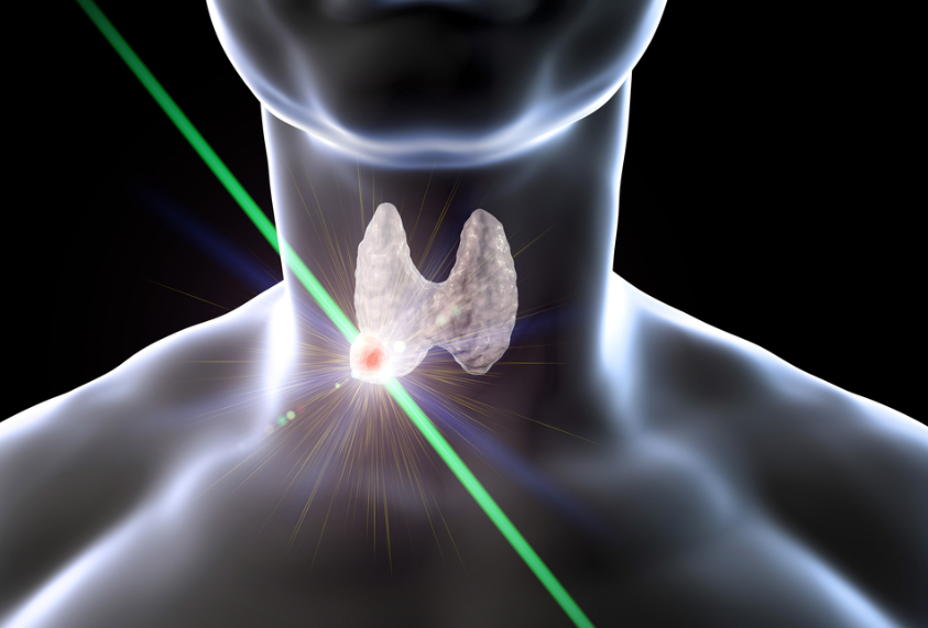 ablação de tireoide