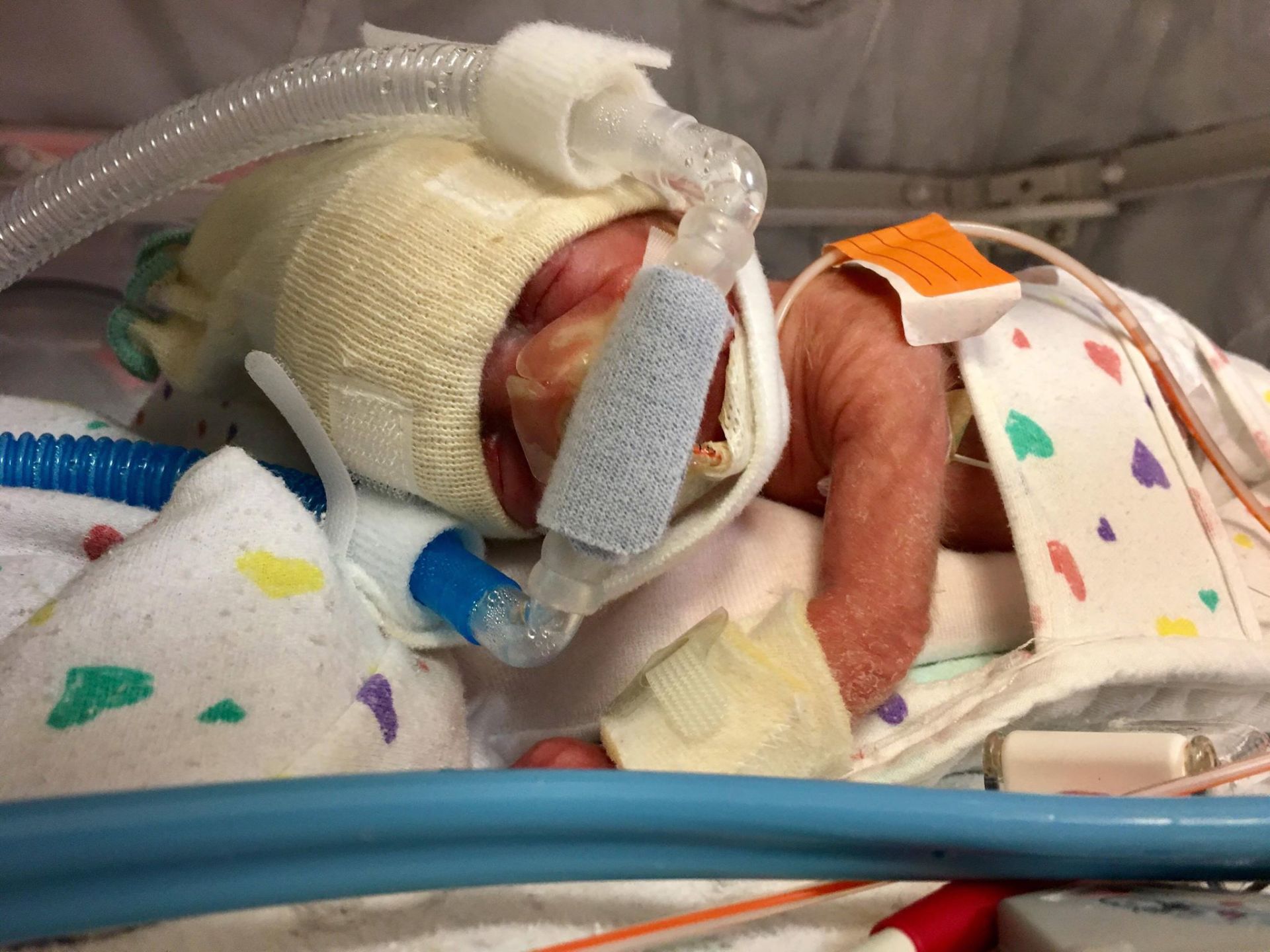 premature baby in the hospital.