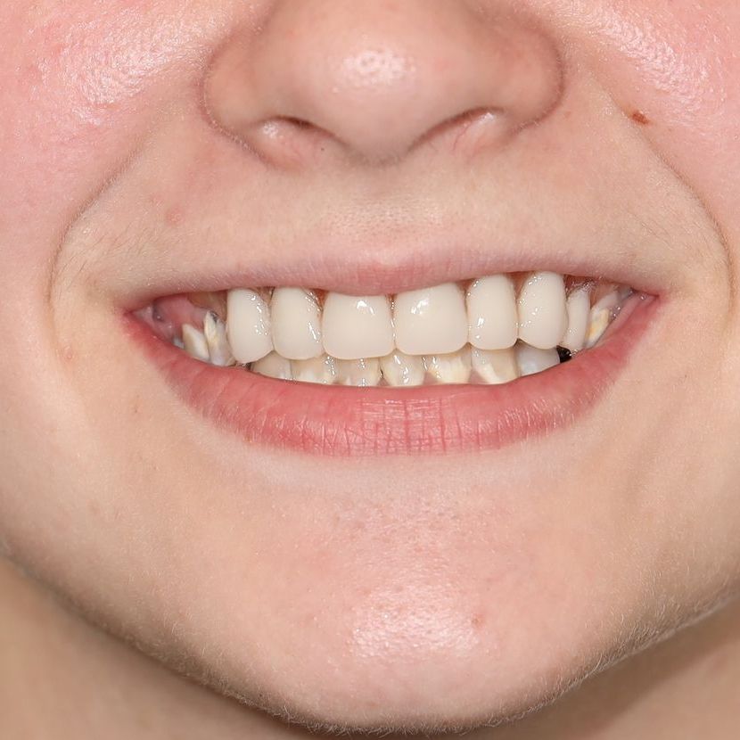 after partial dentures