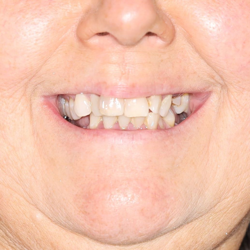 Case-5 before temporary dentures