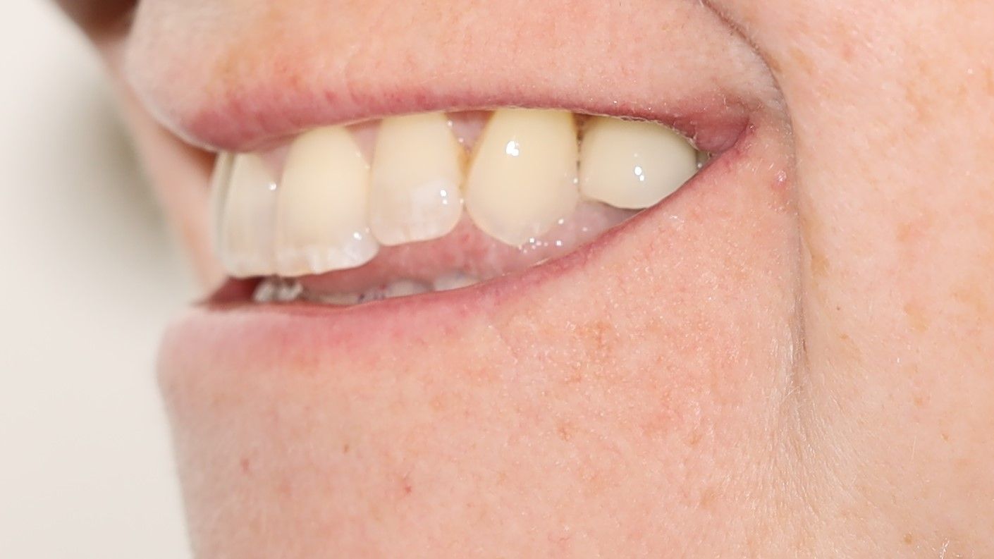 A close up of a person's mouth with their teeth showing after treatment.