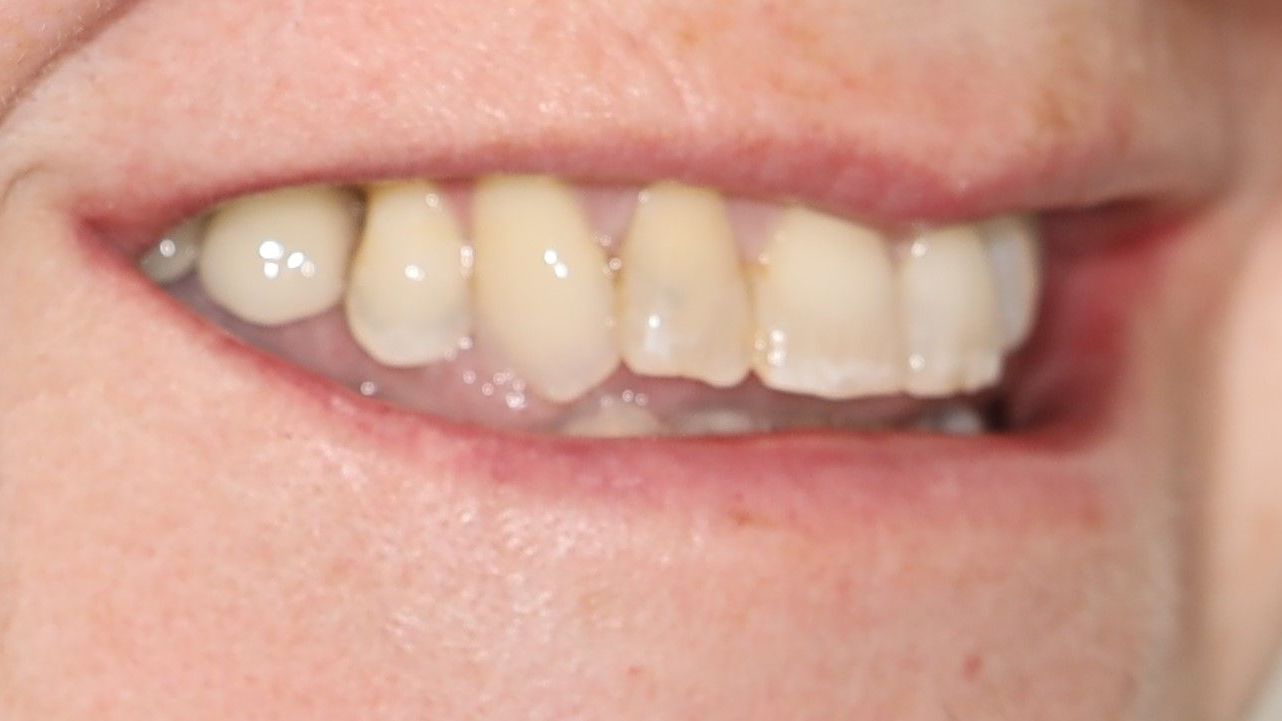 A close up of a person's mouth with their teeth showing after treatment.