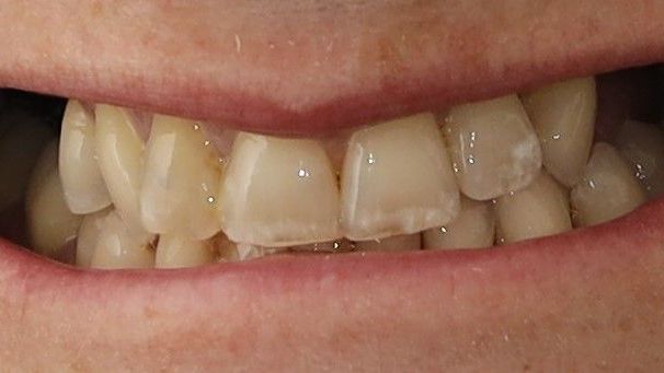 A close up of a person's mouth with their teeth showing before treatment.