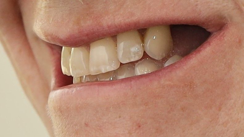 A close up of a person's mouth with their teeth showing before treatment.