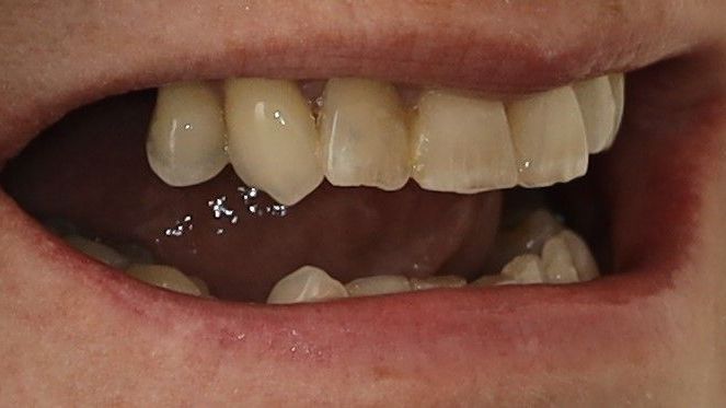 A close up of a person's mouth with their teeth showing before treatment.