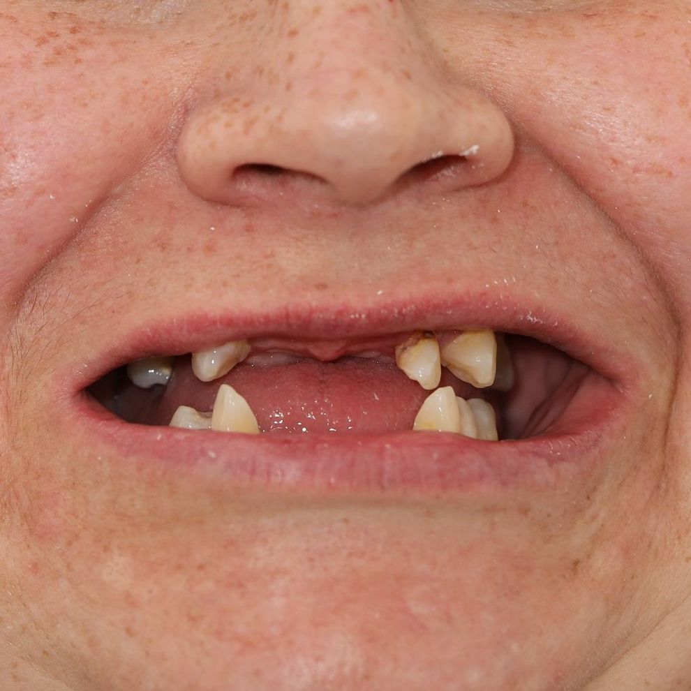 Case-BV before temporary dentures