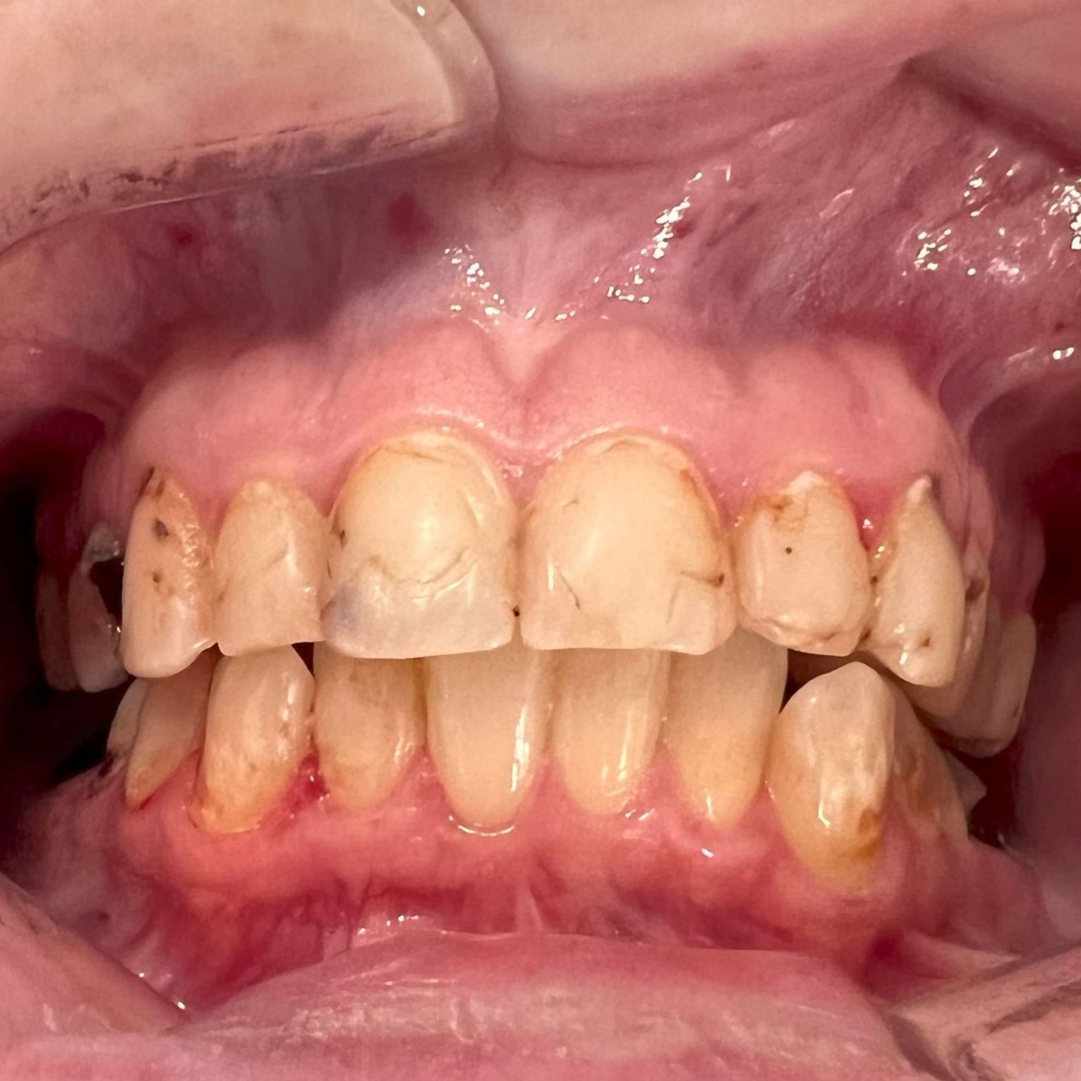 Case-1 before temporary dentures