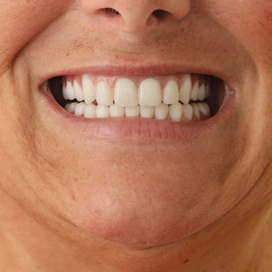 A close up of a person's mouth with their teeth showing after treatment.