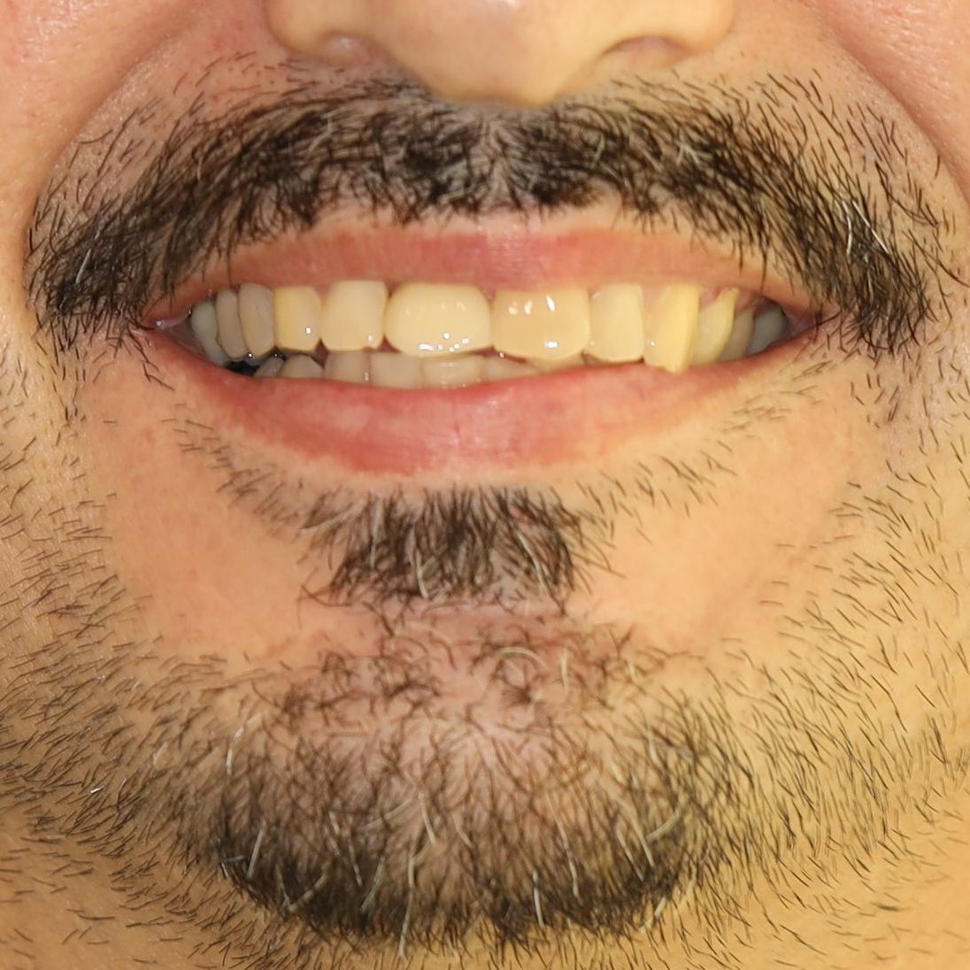 A close up of a person's mouth with their teeth showing after treatment.