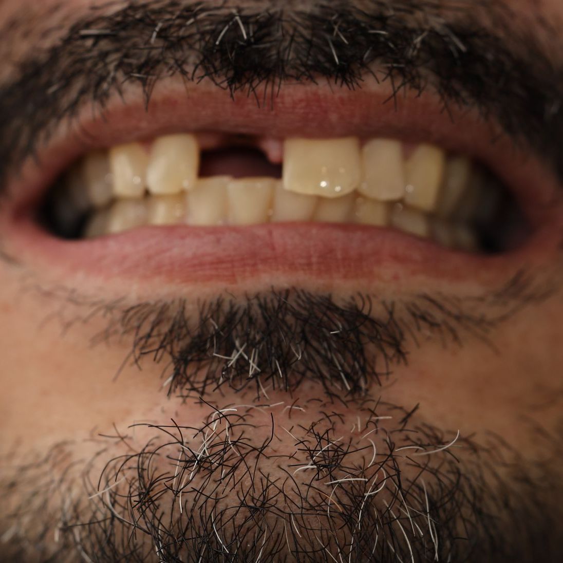 A close up of a person's mouth with their teeth showing before treatment.