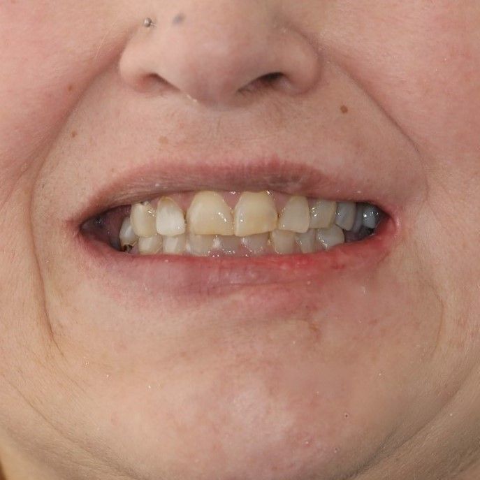 Case-4 before temporary dentures