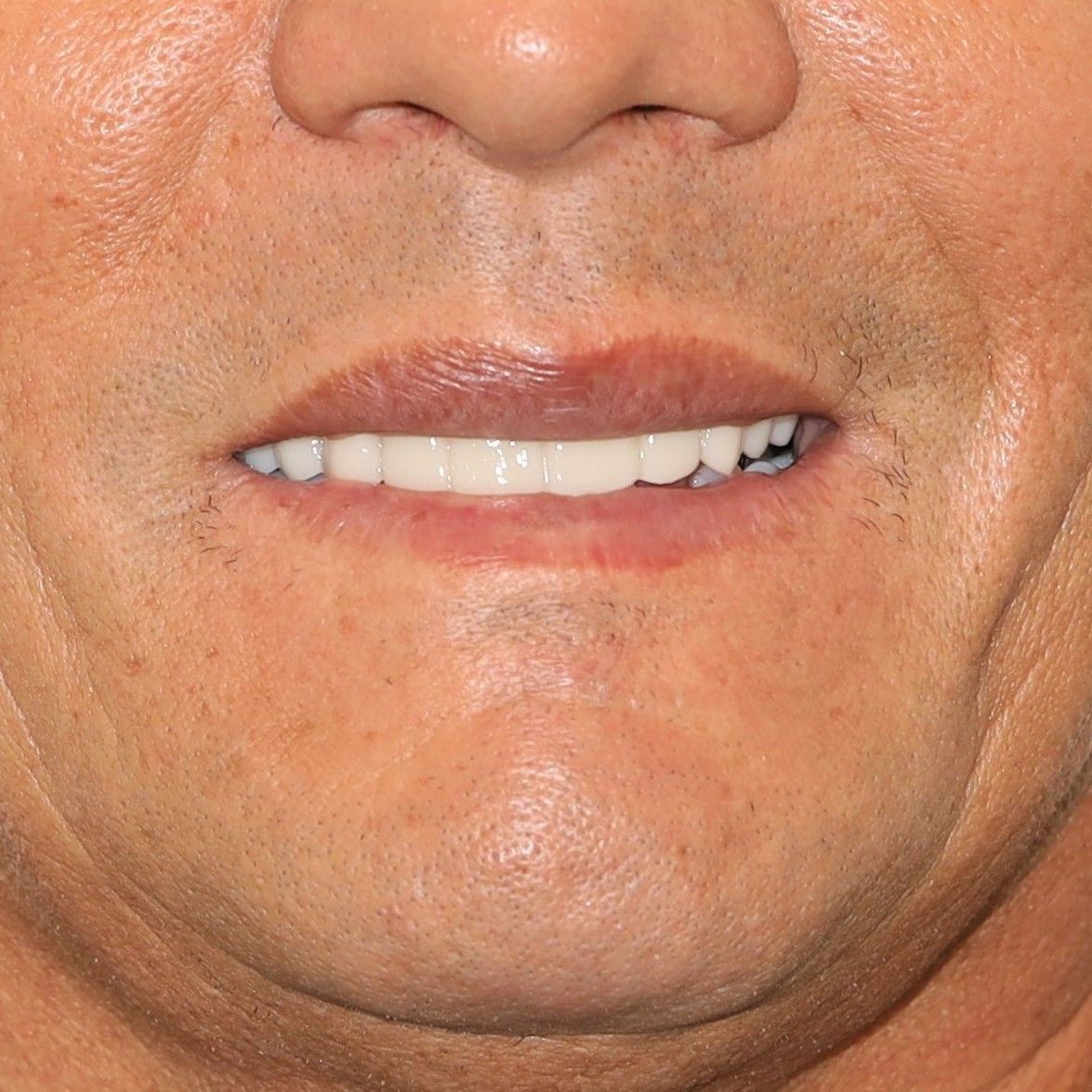 A close up of a person's mouth with their teeth showing after treatment.