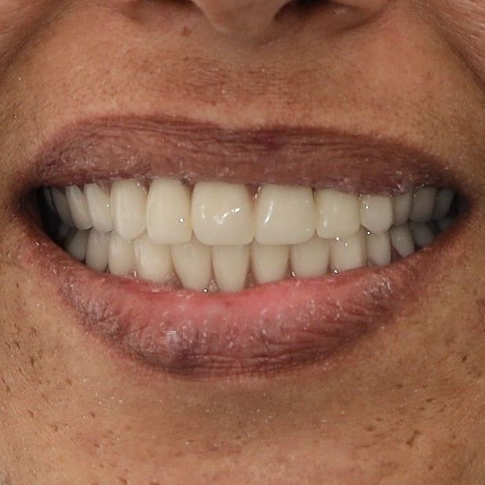 Case-CH after temporary dentures