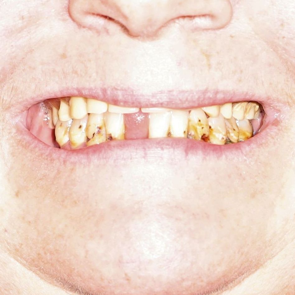 Case-4 before temporary dentures